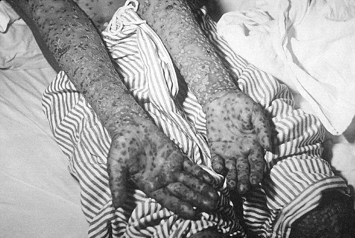 Moment image for Smallpox outbreak in Yugoslavia spreads to affect various regions, including Croatia.