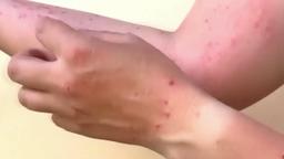 Monkeypox outbreak declared public health emergency