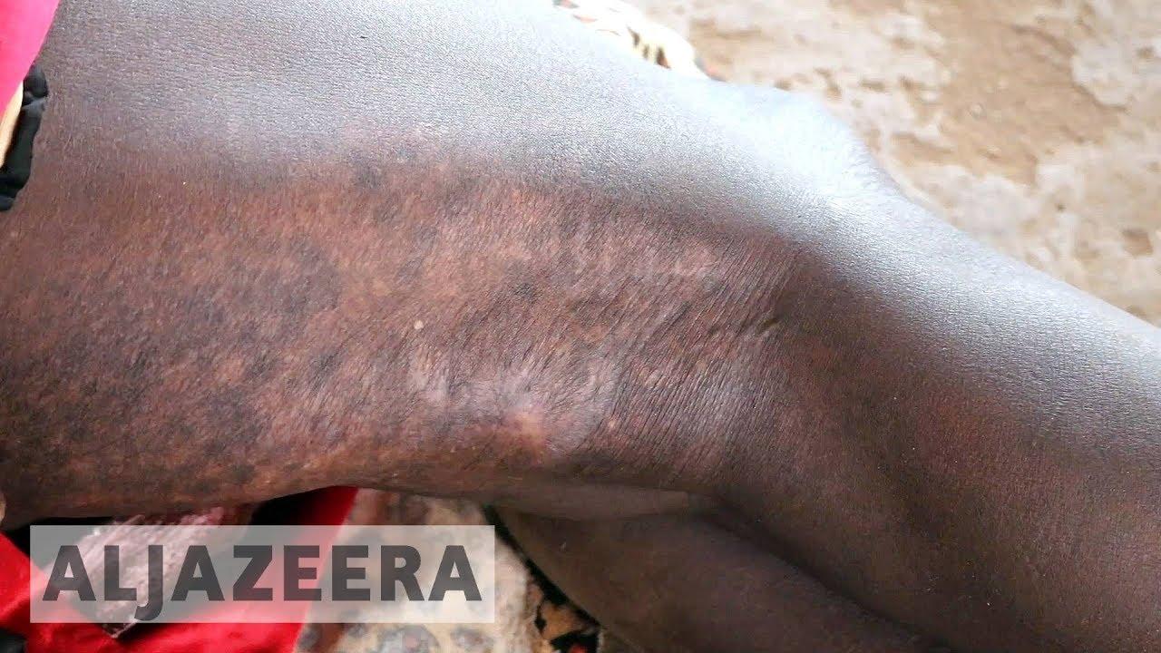 Moment image for UN Reports 600+ Deaths in South Sudan Ethnic Clashes